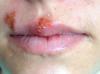 Lippenherpes