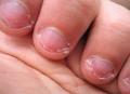 Abgekaute Fingern�gel