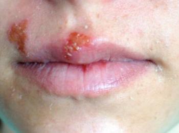 Lippenherpes